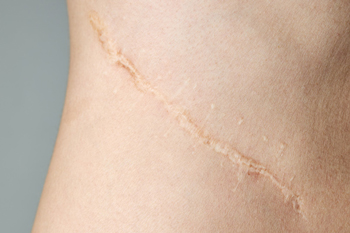 close up of a surgical scar on skin showing healing process 1 health recovery treatment