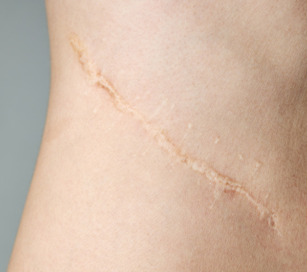 surgical scar on skin showing healing process and skin texture related to recovery and treatment for surgical procedures